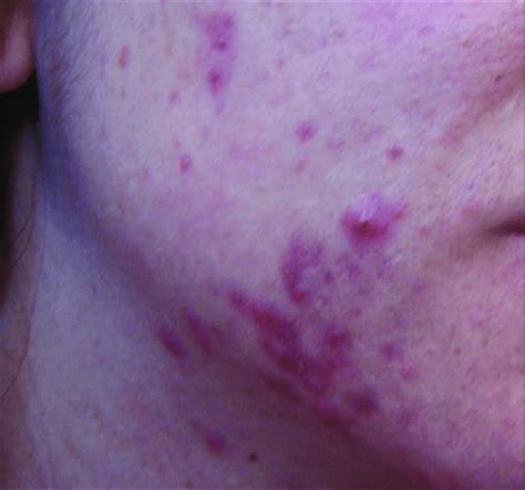 Grade Iv Severe Acne Showing Many Large Inflamed Nodules And Pustules