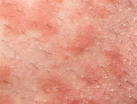 What Triggers Dyshidrotic Eczema