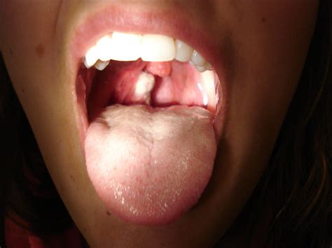 That Gigantic White Thing Its A Hemorrhagic Tonsil Cover Flickr