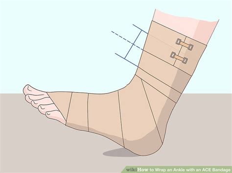 3 Easy Ways To Wrap An Ankle With An Ace Bandage Wikihow