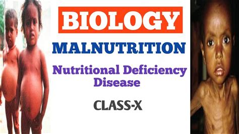 Malnutrition Nutritional Deficiency Diseases Nutrition Biology