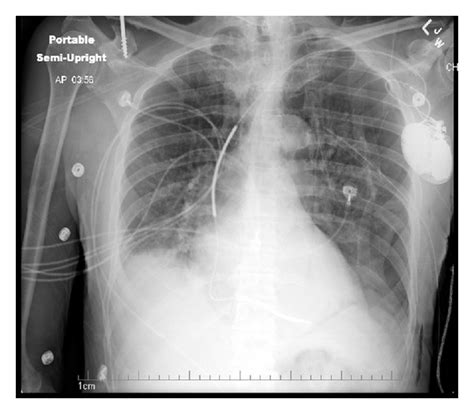 A pneumothorax can be caused by: A Shocking Complication of a Pneumothorax: Chest Tube-Induce
