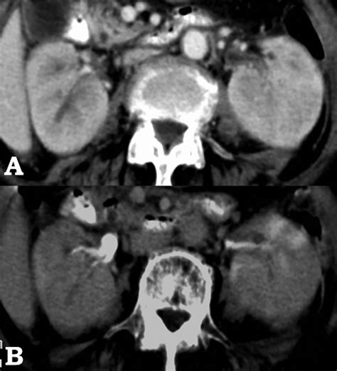 A And B Axial Ct Sections Initial Nephrographic Phase Image A