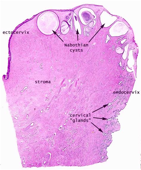 Pathology Outlines Nabothian Cysts