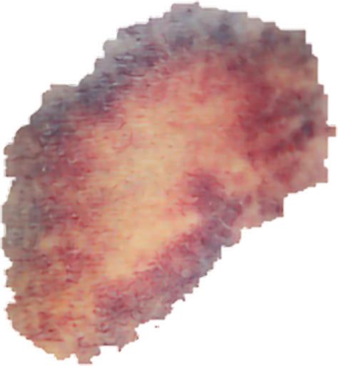 Congratulations The Png Image Has Been Downloaded Bruise Transparent