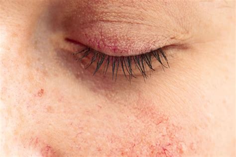 Ocular Rosacea Symptoms Causes And Treatment