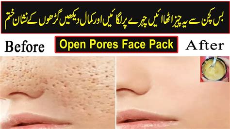 How To Shrink Open Pores Permanently 100 Results Open Pores Treatment At Home Youtube
