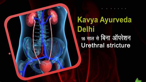 Urethral Stricture Care N Cure 9422188788 Youtube