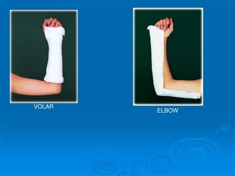 PPT - Fracture of Radius, Ulna, and Humerus PowerPoint ...