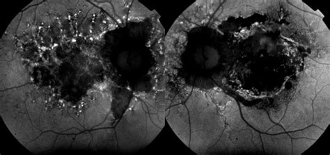 The Right And Left Eyes Of This 57 Year Old With Pseudoxanthoma