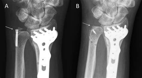 Ulnar Styloid Fractures Symptoms Causes Diagnosis And