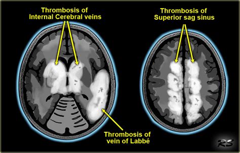 The Radiology Assistant Cerebral Venous Thrombosis