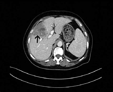 Contrast Enhanced Ct Scan Showed An Enlargement Of The Liver Irregular