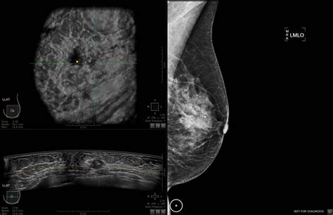 Clinical Evidence Invenia Abus Abus Breast Imaging Ultrasound