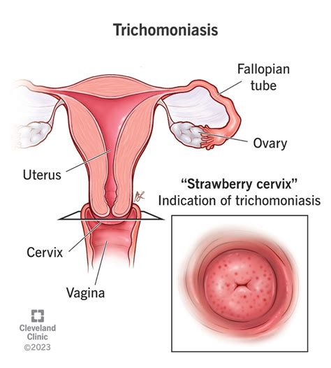 Trichomoniasis Causes Symptoms Testing And Treatment
