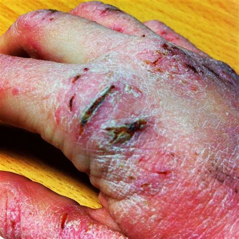 Woman Covered In Severe Eczema Which Caused Snowstorm When She Walked