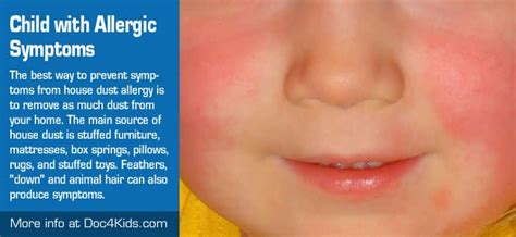 Dealing With A Child With Allergic Symptoms Pediatric Affiliates Of