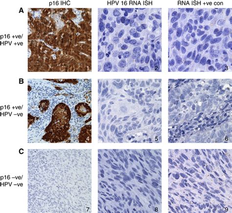 Examples Of Hpv Rna Ish A A P16hpv Positive Case Showing Strong P16