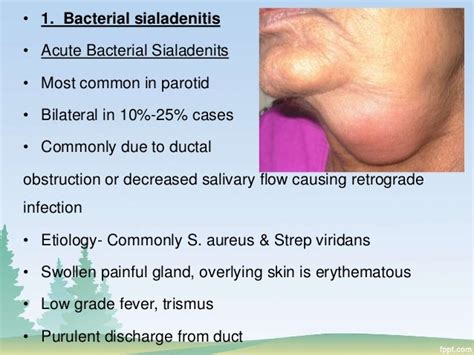 Bacterial Sialadenitis Pdf