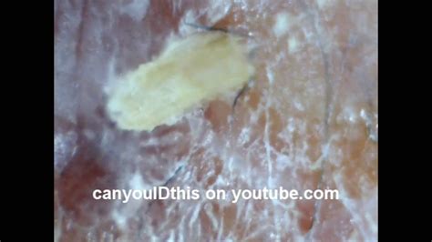 Id This Skin Infection Parasite Nematode Fungus Mrsa Bacterial