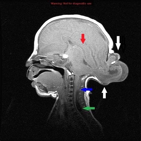 Occipital Meningoencephalocele In A Preterm Neonate Bmj Case Reports