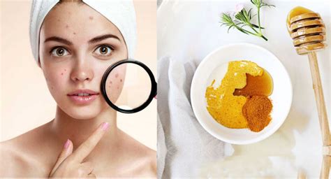 Home Remedies For Acne How To Get Rid Of Pimples B20masala