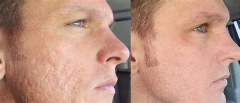 Retinol for acne may be a better choice alternative to dry, peeling, inflamed skin often associated with prescription acne treatments. acne scarring tretinoin gel - Dan the Bodybuilder in Thailand