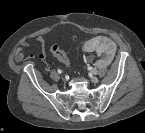 Acute Pyelonephritis In A Renal Transplant Kidney Kidney Case Studies