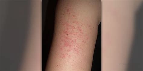 Eczema Skin Rash Information Variuos