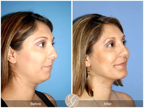 Neck Liposuction Chin Augmentation 27 Before After Photos Orange County
