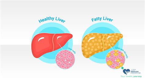 Fatty Liver Just Enough Medicine