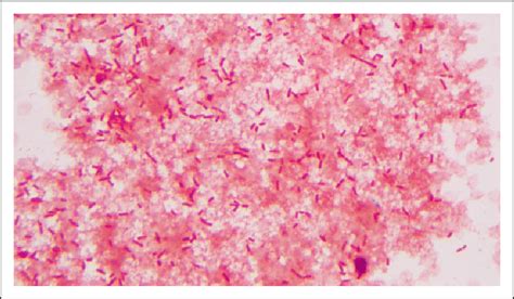 Blood Culture Isolate Gram Stain Â100 The Gram Stain Is Positive For
