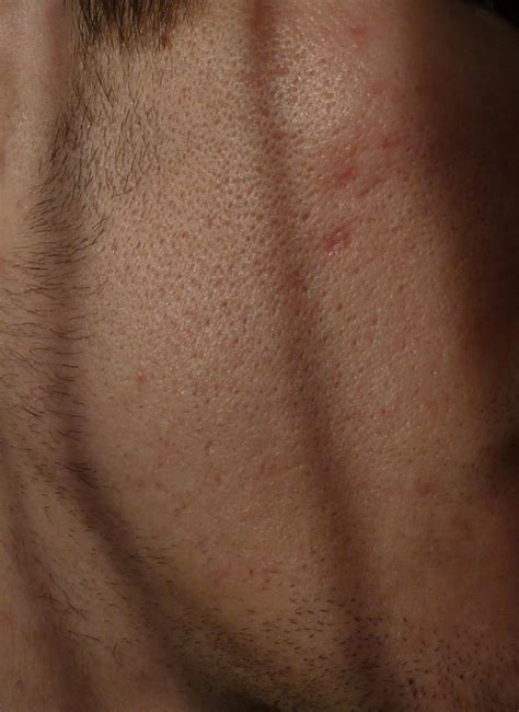 Scarred And Enlarged Pores With Photos Any Suggestions Scar