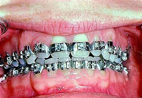 Fullybandedbraces Fullbands Dental Braces Straight Teeth Orthodontics Braces
