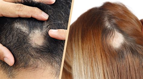 Alopecia Symptoms Causes Of Hair Fall And Its Prevention · Healthkart