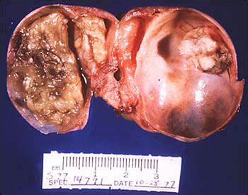 Mature Cystic Teratoma