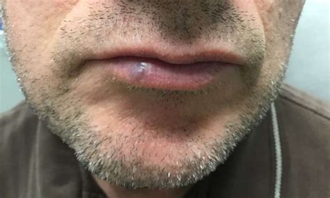 Venous Lake Treatment Spots Dots And Bumps On The Lip Mclean