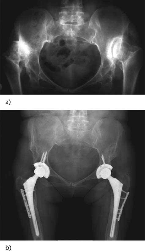 Reconstruction Of Neglected Developmental Dysplasia By Total Hip