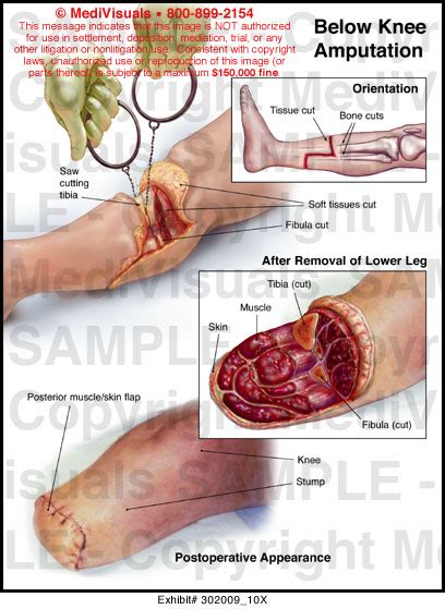 Below Knee Amputation Medical Illustration Medivisuals