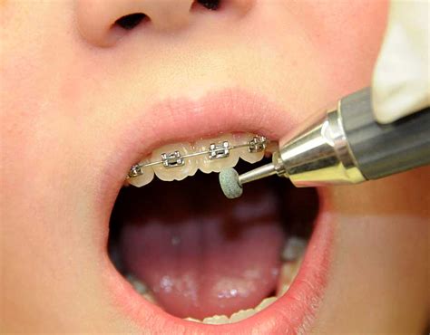 Maybe you would like to learn more about one of these? Removing Tooth Mamelons with a Green Stone - Ask an ...