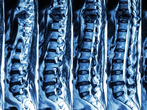 Lumbar Spine Ct Scan Purpose Procedure Risks