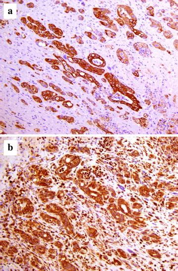 General markers of malignancy and negative markers of mesothelial mesothelioma: Immunohistochemical staining of the mesothelioma ...