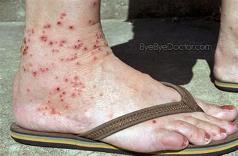Chigger Bite Pictures Symptoms And Treatment