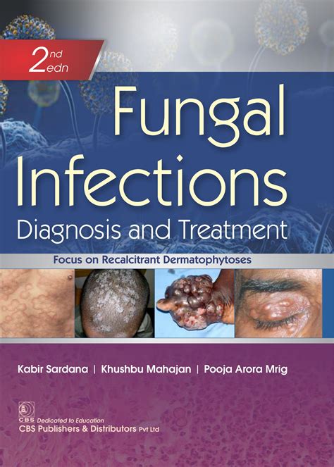 Fungal Infections Diagnosis And Treatment Ubicaciondepersonascdmxgobmx
