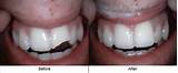 Home Tooth Repair Chipped Tooth Images