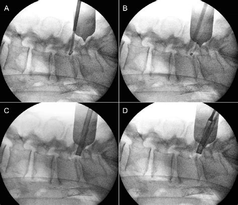 Intraoperative Fluoroscopic Imaging Of A Guidewire Passage B