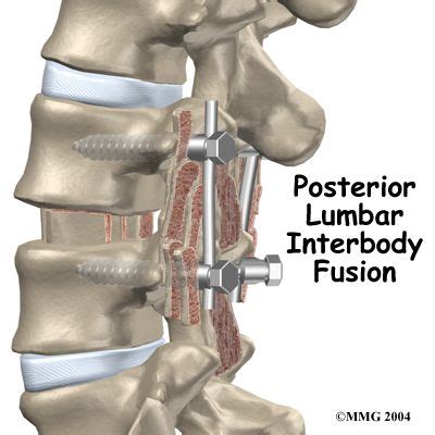 Posterior Lumbar Interbody Fusion Introduction Spinal Fusion Spinal Fusion Surgery Spine Surgery