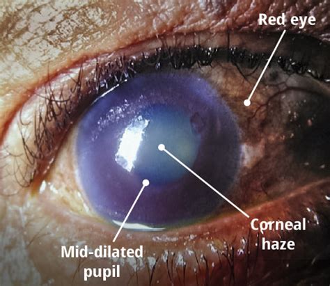 Acute angle closure glaucoma completely blocks your canals. Community Eye Health Journal » Emergency management: angle ...