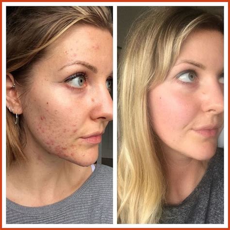 acne scar treatment reviews doctor approved treatments that work dubai dubai laser treatment