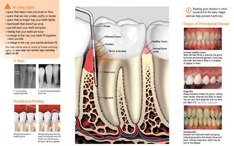 Periodontics Dental Implant Speciality Centre